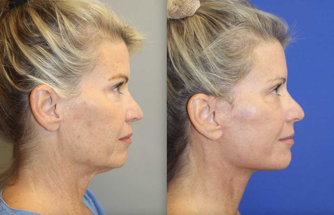 Facelift before and after photos (profile view)